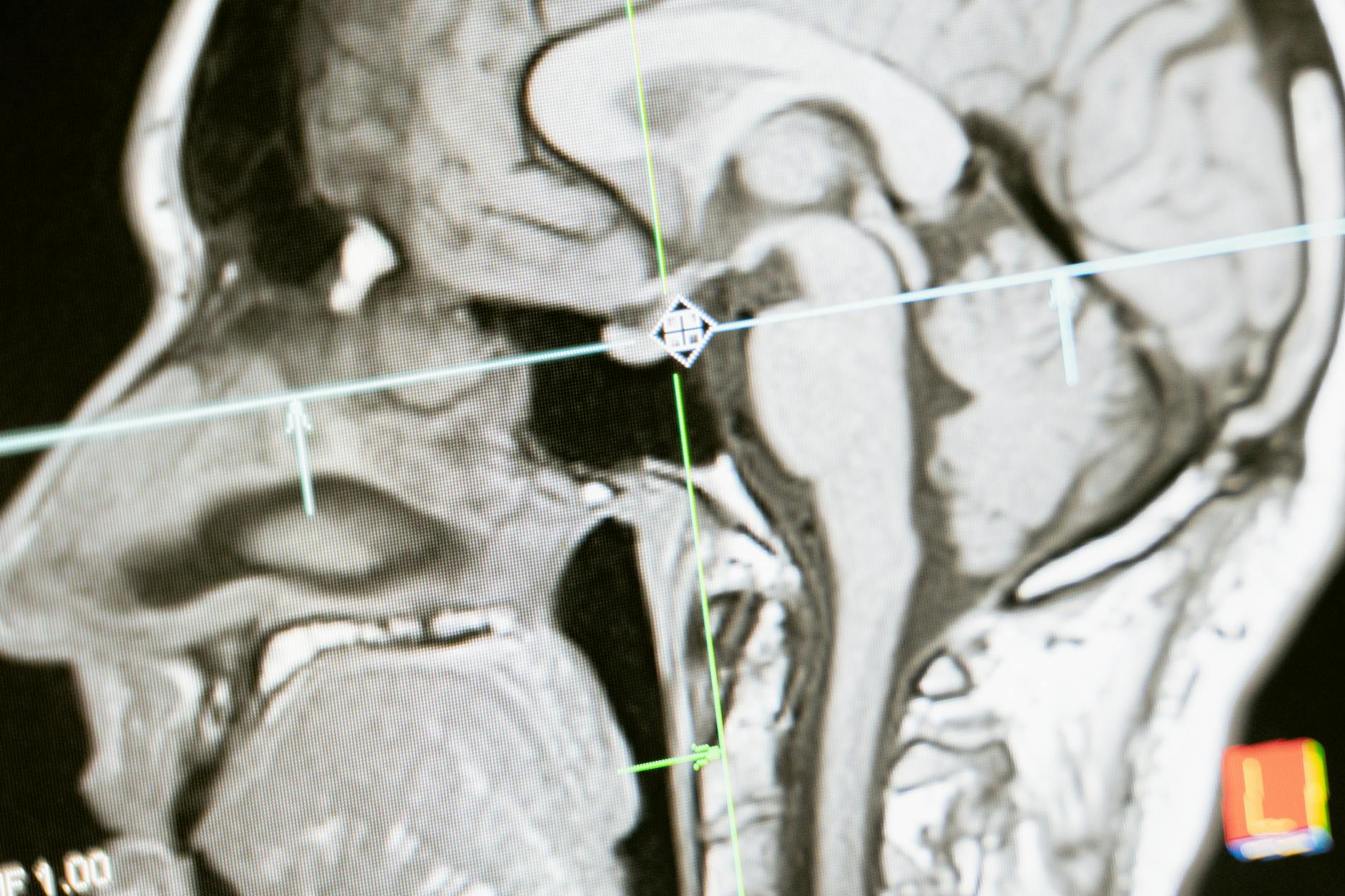 long COVID research - brain scan fatigue