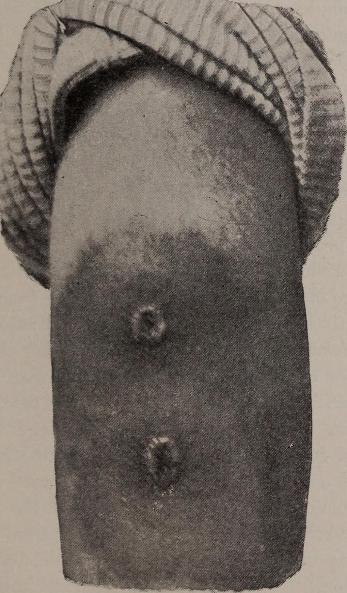 measles rash symptoms - clinical